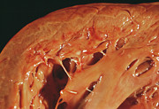 Heart After Heart Attack #3 Photograph by Science Photo Library