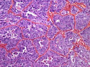 Lung Cancer #3 Photograph by Science Photo Library