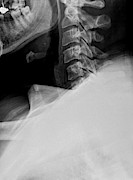 X-ray Of A Human Cervical Spine #3 Photograph by Science Photo Library