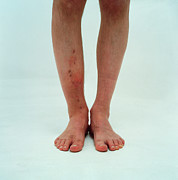 Broken Leg #4 Photograph by Science Photo Library