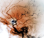 Cerebral Aneurysm #7 Photograph by Science Photo Library