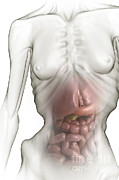 Anorexia #9 Photograph by Science Picture Co Anorexia #9 Photograph by Science Picture Co