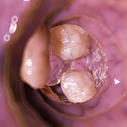 Colon Cancer #9 Photograph by Science Photo Library