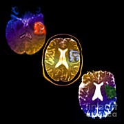 Acute Stroke Photograph by Living Art Enterprises