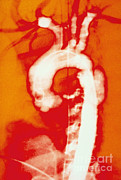 Aortic Aneurysm Photograph by Lunagrafix