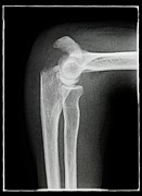 Broken Elbow Photograph by Science Photo Library
