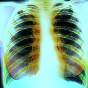 Chest X-ray Of Lungs With Cystic Fibrosis Greeting Card by Simon Fraser ...