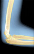 Child's Elbow Photograph by Science Photo Library