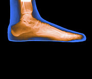 Coloured X-ray Of A Woman's Flat Foot Photograph by Science Photo Library