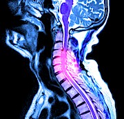 Compressed Spinal Cord Photograph by Science Photo Library