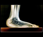 Flat Foot Photograph by Science Photo Library