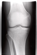 Healthy Knee Photograph by Science Photo Library