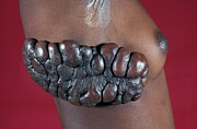 Keloid Scar Photograph by Science Photo Library
