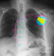 Pacemaker Photograph by Scott Camazine Pacemaker Photograph by Scott Camazine
