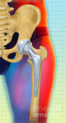 Prosthetic Hip Replacement Photograph by Chris Bjornberg Prosthetic Hip Replacement Photograph by Chris Bjornberg