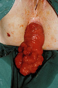 Rectal Adenoma Protruding Through Anus Photograph by Science Photo Library