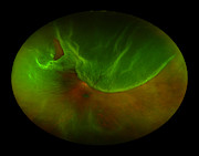 Retinal Detachment Photograph by Paul Whitten Retinal Detachment Photograph by Paul Whitten