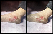 Tertiary Syphilis, Vintage Stereoscopic Photograph by DoubleVision