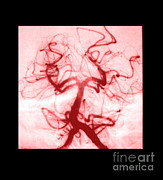 Angiogram Of Embolus In Cerebral Artery #2 Photograph by Medical Body Scans
