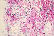 Pap Smear Cancer #3 Photograph by Science Source