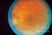 Diabetes And Cataracts Photograph by Science Source