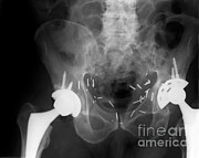Double Hip Replacement Photograph by Ted Kinsman Double Hip Replacement Photograph by Ted Kinsman