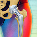 Prosthetic Hip Replacement Photograph by Chris Bjornberg Prosthetic Hip Replacement Photograph by Chris Bjornberg