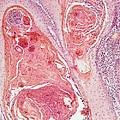 Anal Squamous Cell Carcinoma, Lm Photograph by Garry DeLong Anal Squamous Cell Carcinoma, Lm Photograph by Garry DeLong