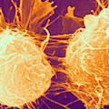 Neuroblastoma, Sem by Biology Pics Neuroblastoma, Sem by Biology Pics