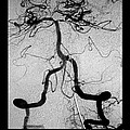 Cerebral Angiogram Photograph by Medical Body Scans Cerebral Angiogram Photograph by Medical Body Scans