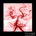 Angiogram Of Embolus In Cerebral Artery Photograph by Medical Body Scans Angiogram Of Embolus In Cerebral Artery Photograph by Medical Body Scans