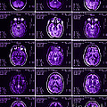 Mri Of Normal Brain by Science Source Mri Of Normal Brain by Science Source