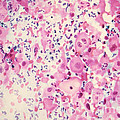 Pap Smear Cancer 3 by Science Source Pap Smear Cancer 3 by Science Source