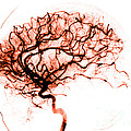 Cerebral Angiogram Photograph by Medical Body Scans Cerebral Angiogram Photograph by Medical Body Scans