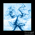 Angiogram Of Embolus In Cerebral Artery Photograph by Medical Body Scans Angiogram Of Embolus In Cerebral Artery Photograph by Medical Body Scans