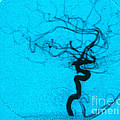 Cerebral Angiogram Photograph by Science Source Cerebral Angiogram Photograph by Science Source