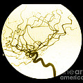 Internal Carotid Cerebral Angiogram Photograph by Medical Body Scans Internal Carotid Cerebral Angiogram Photograph by Medical Body Scans