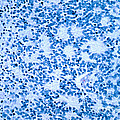 Neuroblastoma by Science Source Neuroblastoma by Science Source