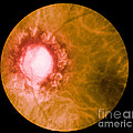 Retina Infected By Syphilis Photograph by Science Source Retina Infected By Syphilis Photograph by Science Source
