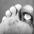 Syphilis Ulcer Photograph by Science Source Syphilis Ulcer Photograph by Science Source