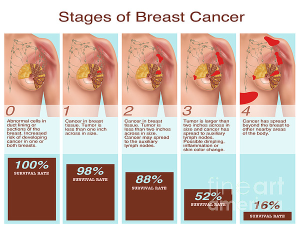 Breast Cancer Stages, Illustration Yoga Mat by Gwen Shockey - Fine