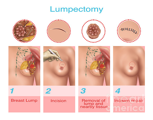 Brass after lumpectomy 