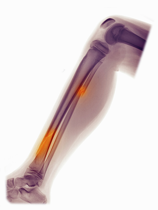 X-ray Of Leg Showing Fracture Of Fibula And Tibia Greeting Card by ...