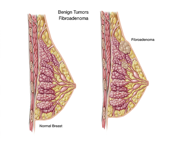 Benign Fibroadenoma Tumor In Breast iPhone 13 Case by Elise
