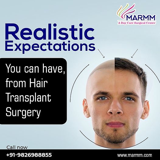 Realistic Expectation You Can You Can Have From Hair Transplant in Indore  Tank Top by Marmm Clinic - Pixels