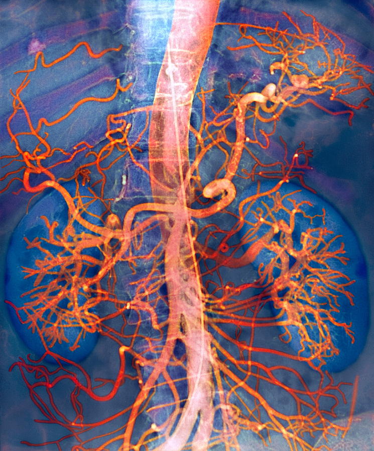 Abdominal Arteries, X-ray #1 Photograph by Cnri