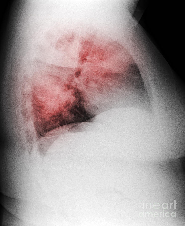 Atypical Pneumonia In Smoker, X-ray #1 Photograph by Scott Camazine