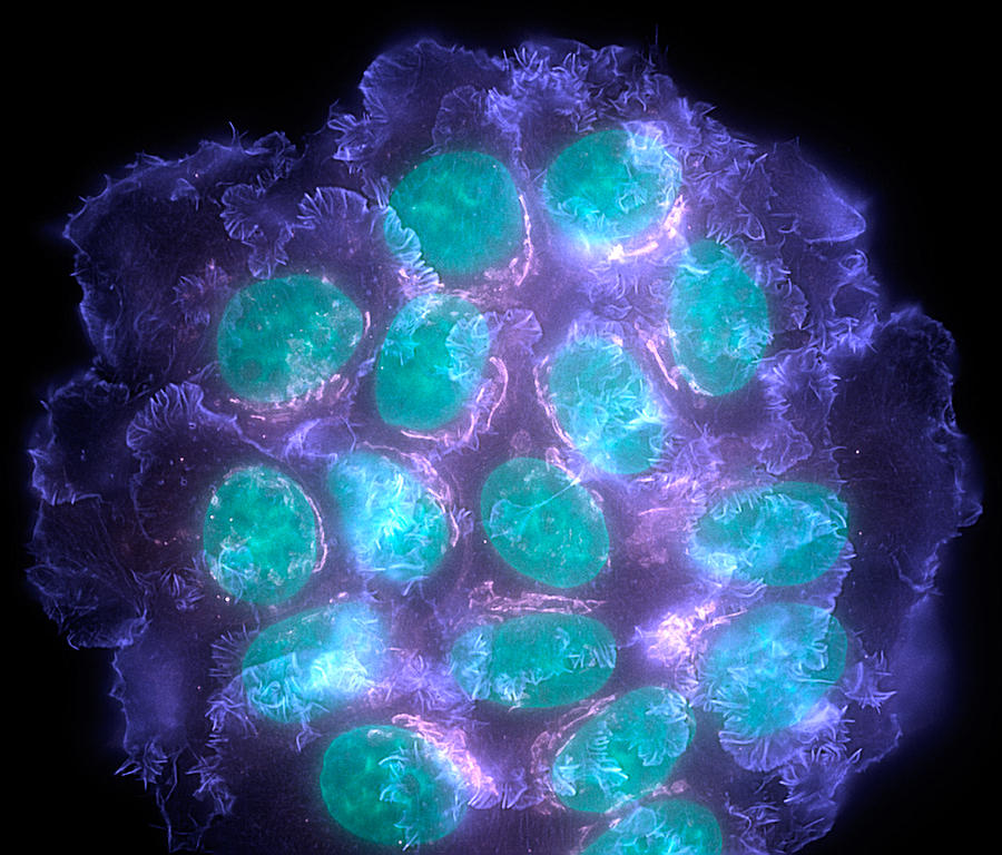 Disease Photograph - Breast Cancer Cells, Light Micrograph #1 by Dr Torsten Wittmann