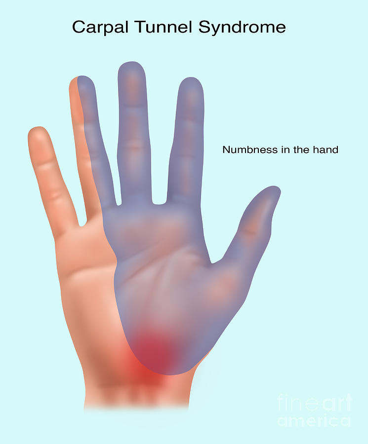 Carpal Tunnel Syndrome, Illustration Photograph by Gwen Shockey - Fine ...