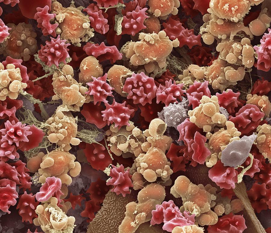 Abnormal Photograph - Cells From A Urine Infection, Sem #1 by Steve Gschmeissner
